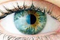  ما هي جلطة العين وما هي أعراضها؟