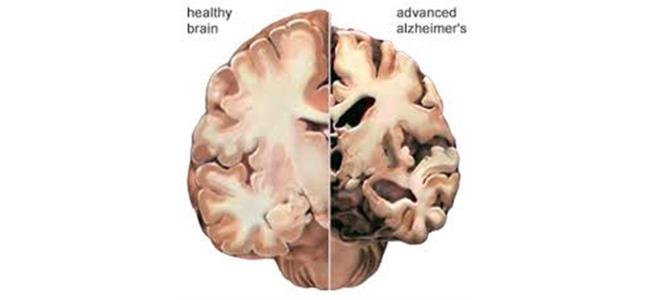  أخيراً: عقار يوقف استفحال الزهايمر..وتهليل