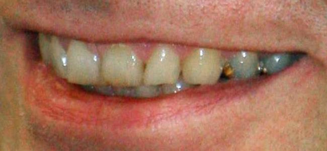  ما هي أفضل وسيلة لتعويض سقوط الأسنان؟