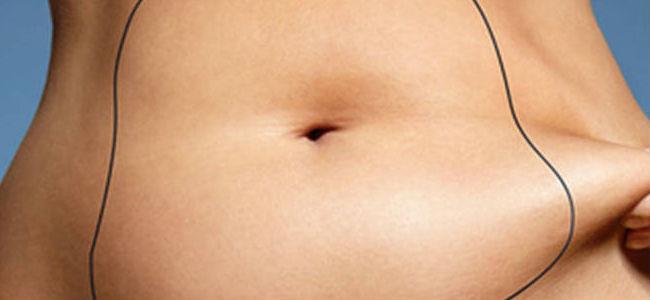  تقنيّة الـCoolSculpting لإذابة الدهون في وقت قياسي