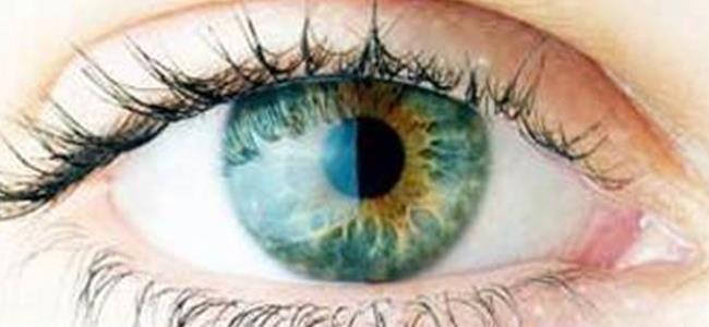  ما هي جلطة العين وما هي أعراضها؟