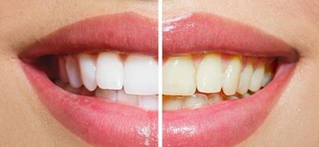 كيف تتخلصون من صفار الأسنان بطرق طبيعية؟