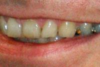  ما هي أفضل وسيلة لتعويض سقوط الأسنان؟