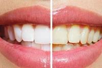 كيف تتخلصون من صفار الأسنان بطرق طبيعية؟